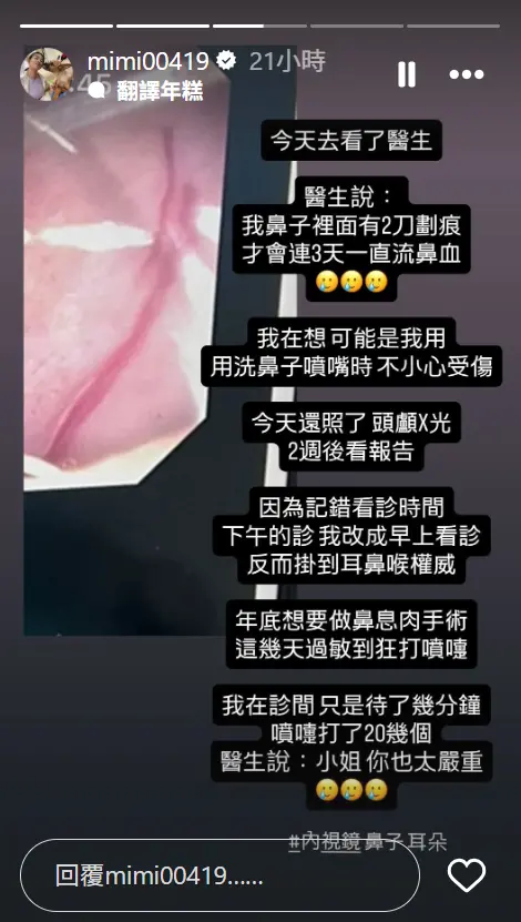 ▲米可白鼻血狂流後送醫檢查！鼻子裡驚見2刀劃痕　曝因1症狀將開刀。（圖／米可白IG@mimi00419）