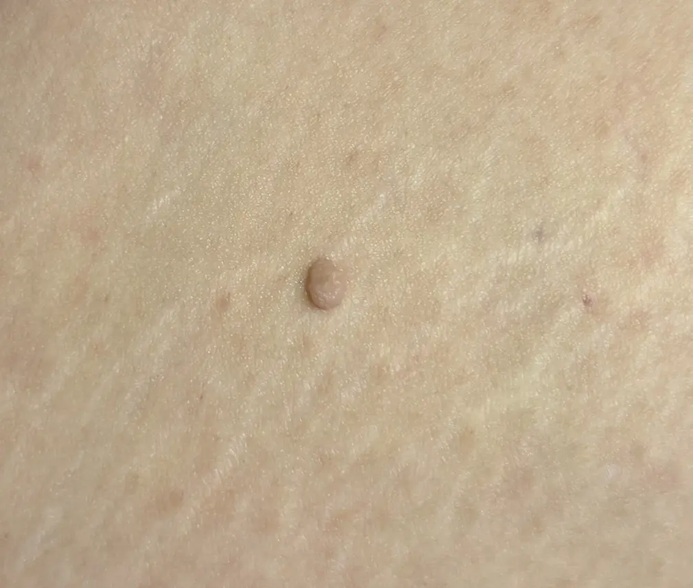 ▲一名女性突然出現凸起物，檢查為贅生皮。（圖／書田診所提供）