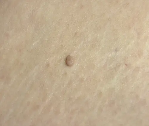 43歲女突冒「詭異腫塊」！醫檢查：贅生皮　3類人較容易出現
