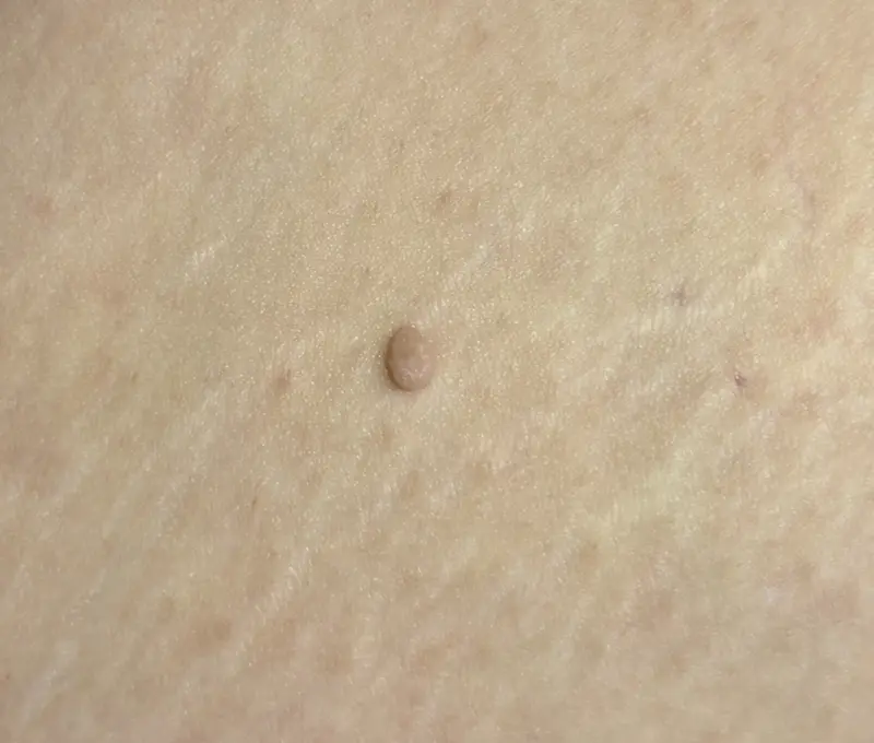 ▲一名女性突然出現凸起物，檢查為贅生皮。（圖／書田診所提供）