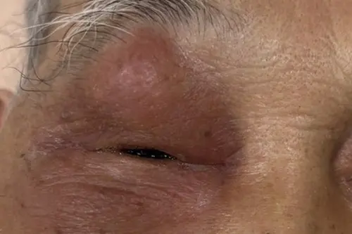 84歲爺右眼腫痛！送急診「急性鼻竇炎」　醫：一週沒好轉快就醫
