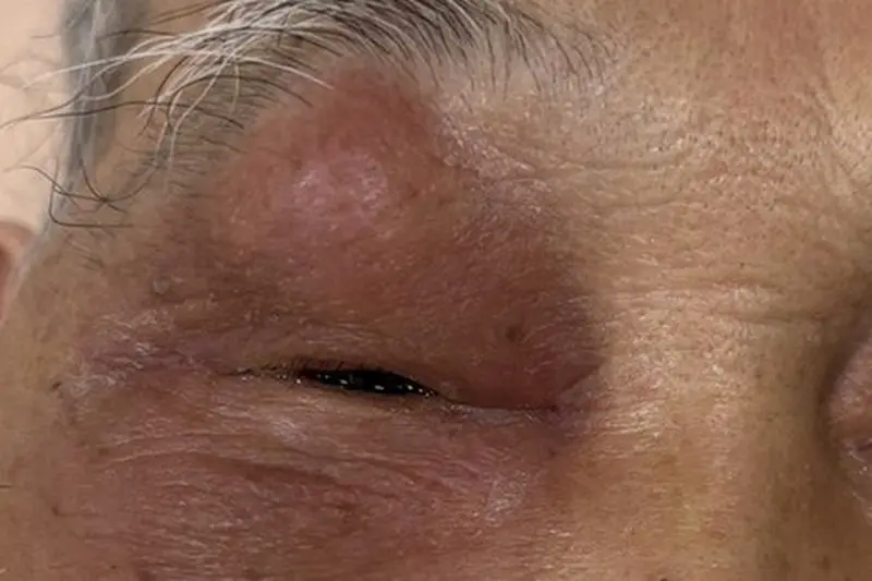 ▲一名84歲的患者突然出現右眼腫脹，直到過了2週出現疼痛、影響視野，診斷為急性鼻竇炎併發右眼上皮膿瘍。（圖／台北慈濟醫院提供）