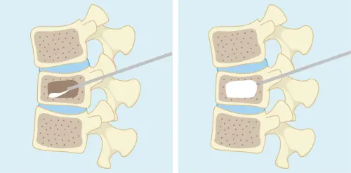 ▲醫師操作微創骨水泥灌注手術會先精準定位，再透過細針將特製骨水泥注入受損椎體。（圖／北市聯醫提供）