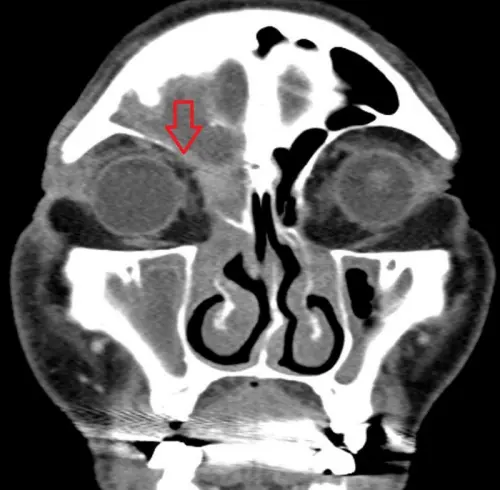 ▲電腦斷層檢查顯示，李爺爺鼻竇阻塞，與眼周邊界模糊。（圖／台北慈院提供）