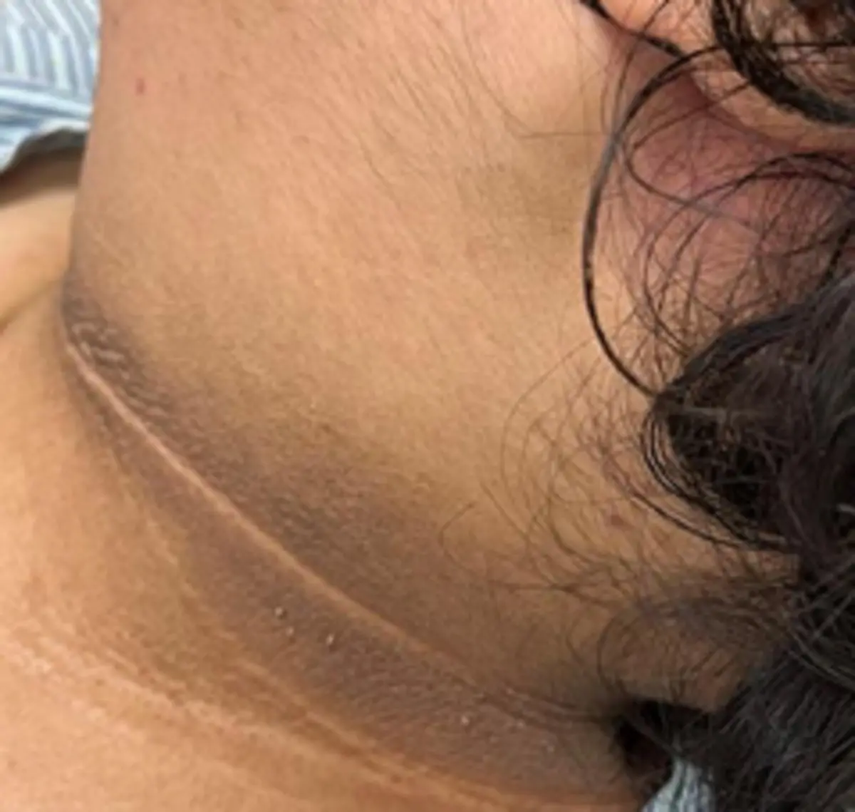 ▲兒童頸部皮膚若出現發黑、粗厚的現象，可能為「黑棘皮症」，為肥胖及糖尿病前期徵兆，家長要多注意。（圖／新竹台大分院提供）