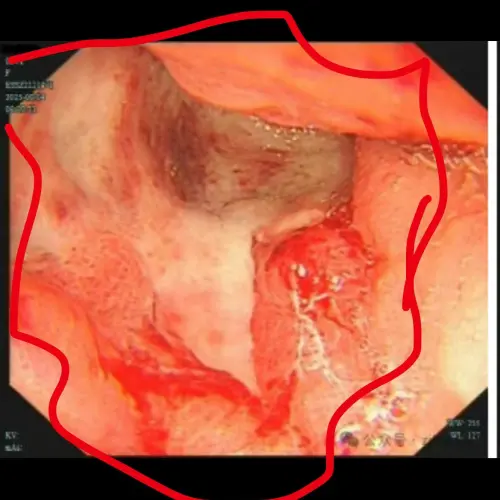▲小雯（化名）以自身經歷，呼籲外界要注意自己的身體。（圖／翻攝自微博）