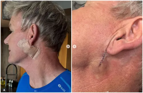 ▲「地獄廚神」罹皮膚癌！戈登拉姆齊傷疤曝光（圖／IG@gordongram）