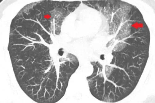 ▲▼魏先生胸部影像檢查有大片白影，診斷結果卻非肺炎，而是「蛋白質沉積症」。（圖／台北慈院提供）
