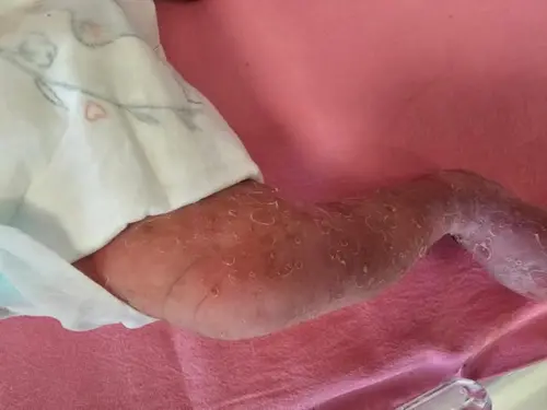 女嬰罹罕病「色素失調症」 醫籲：早期診斷可正常成長
