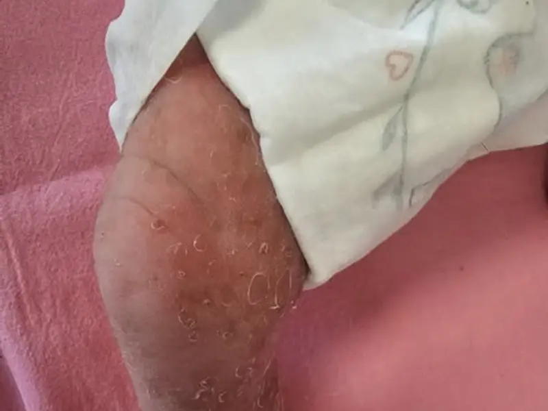 ▲女嬰確診「色素失調症」，全身冒出小水泡般紅疹，皮膚明顯脫屑。（圖／亞大醫院提供）