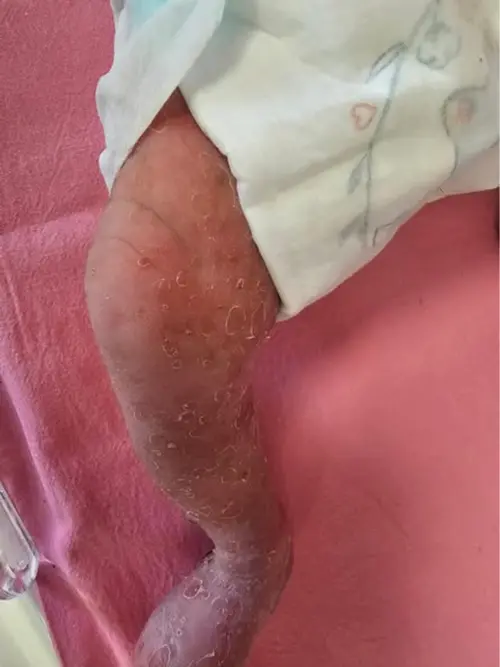 ▲女嬰確診「色素失調症」，全身冒出小水泡般紅疹，皮膚明顯脫屑。（圖／亞大醫院提供）