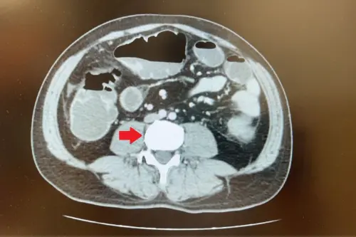 ▲蘇先生的電腦斷層影像可發現降結腸處有5公分大腫瘤，並造成腸阻塞。（圖／台北慈院提供）