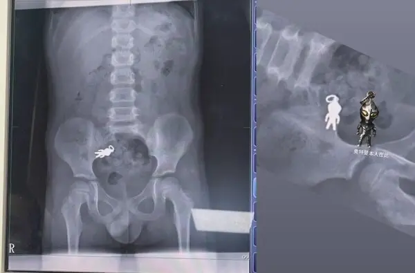 首位合體！7歲童誤吞「超人力霸王」吊飾　X光片畫面曝光網友笑翻
