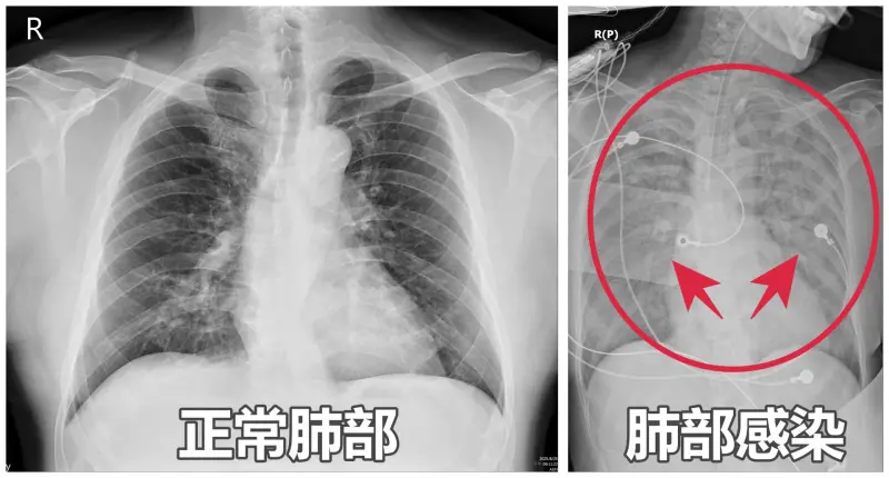 ▲闆娘嗜睡、胃口差，檢查竟發現「雙肺全白」 已染肺炎。（圖／亞大醫院提供）