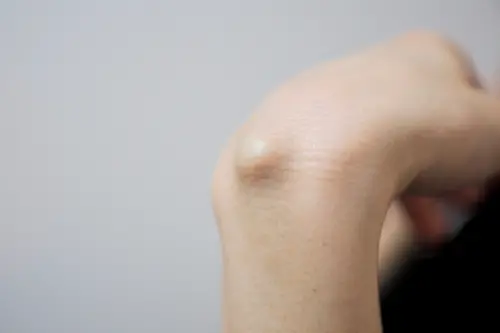 ▲全身只要有脂肪的部位都有可能發生脂肪瘤，多數是良性。（示意圖／取自photoAC）