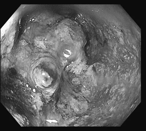 ▲醫師透過大腸鏡檢查發現，腫瘤幾乎塞住整條腸道，正是患者⻑期血便與腹痛的主因。（圖／禾馨醫療提供）
