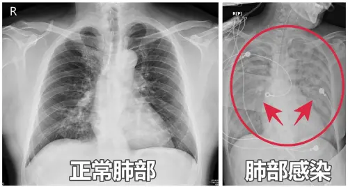 65歲女嗜睡、胃口差！如「靈魂出竅」　醫一照：雙肺全白
