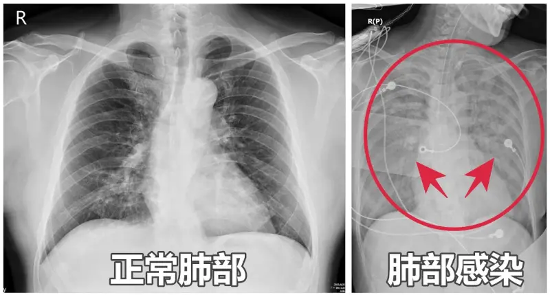 ▲患者因嗜睡、久咳不停就醫，結果肺部X光檢查呈現「全白」。（圖／亞大醫院提供）