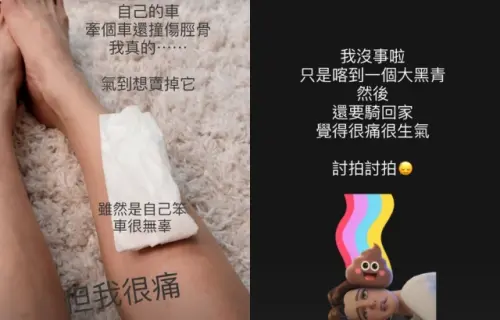 ▲吳婉君牽車撞傷脛骨！小腿傷勢曝　又痛又氣發文討拍：氣到想賣掉。（圖／吳婉君IG@cocco__wu）