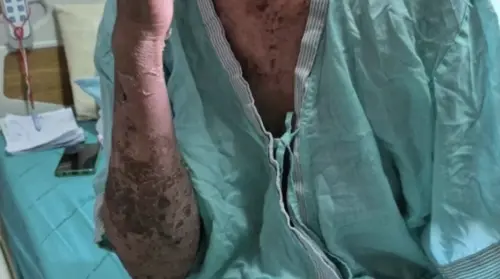 泰國女菜販誤信偏方治帶狀皰疹　險因嚴重血液感染喪命
