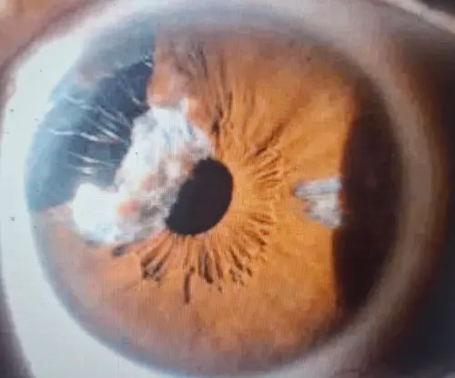 白內障手術前切記　服用這藥物再不好意思也要告知醫師
