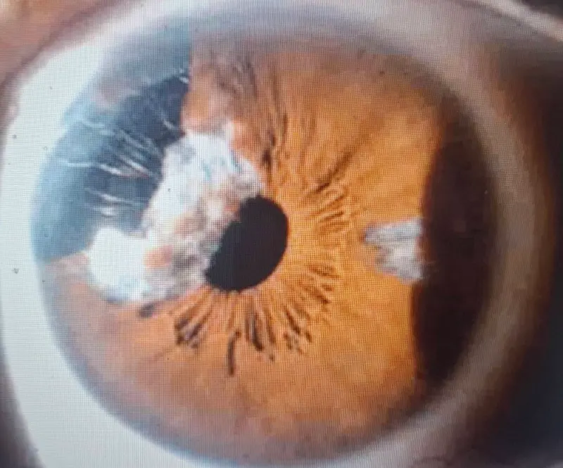 ▲服用坦索羅辛的白內障患者在進行水晶體乳化術，發現虹膜的波浪狀移動，甚至虹膜脫垂出現，極容易卡住器械，使手術實施困難。（圖／洪啟庭醫師提供）