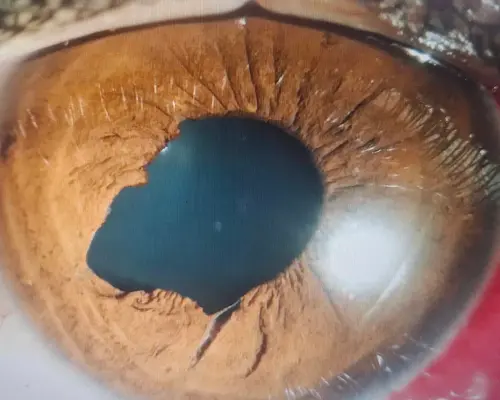 ▲白內障患者可能合併角膜水腫。（圖／洪啟庭醫師提供）