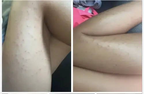 ▲爆料者在網上貼出孩子身上的紅疹之照片，並提到經醫生診斷「病灶可能由床蝨所引起」。（圖／翻攝爆料公社）