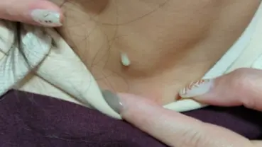 ▲女童自小頸部便有小洞，長期流出分泌物，後確診鰓裂囊腫。（圖／萬芳醫院提供） 