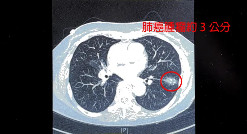 ▲75歲女曾染肺結核，日前健檢發現罹患肺癌。（圖／中醫大新竹附醫提供）
