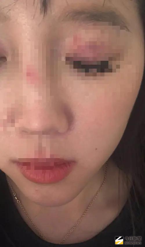 ▲ 20號英國倫敦發生台灣人被英國青少女攻擊事件，陳姓女子臉部多處受傷，眼皮紅腫瘀青，鼻子嘴巴都有傷痕。（圖／翻攝畫面）