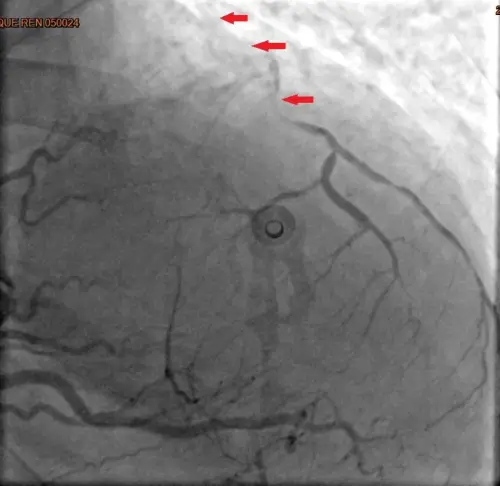 ▲林小姐的心導管顯示3條冠狀動脈嚴重阻塞。（圖／台北慈願提供）