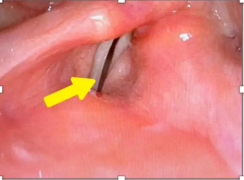 ▲手術前（上）左側假聲帶會過度用力代償且聲帶無法閉合，手術後（下）左側假聲帶不用再出力且聲帶可閉合。（圖／馬偕醫院提供）