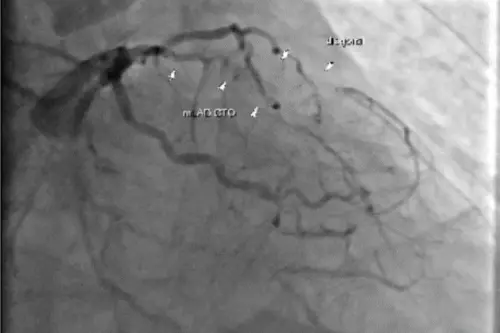 不吃藥害心臟衰竭！57歲男驚險3度手術　換心獲新生
