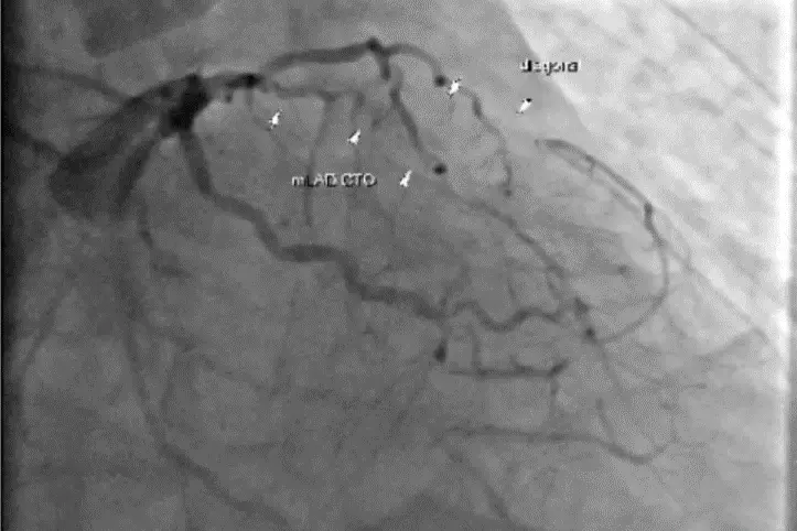 ▲57歲的周先生自行停用抗血小板藥物多年，導致血管逐漸阻塞，最終引發重度心臟衰竭，心導管可發現3條冠狀動脈全數堵塞。（圖／台北慈院提供）
