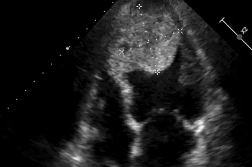 ▲超音波檢查發現心臟有5公分大血栓。（圖／台北慈院提供）