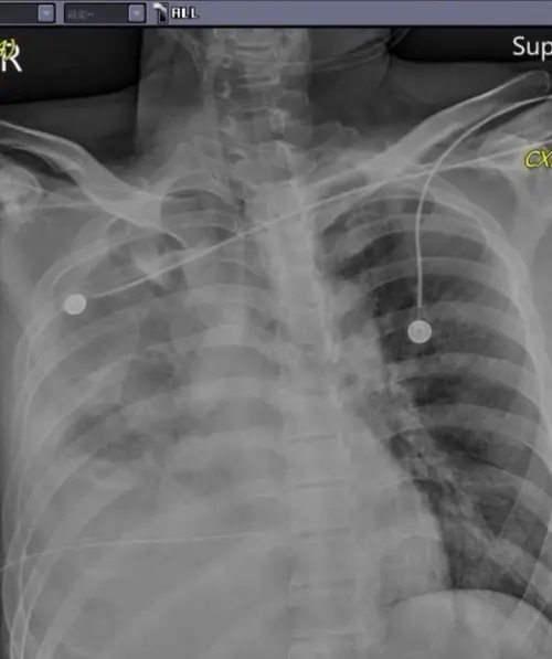 苗栗隨機砍人案被害者大出血　醫怒：穿刺很深，是怎樣的深仇大恨
