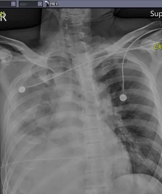 ▲苗栗發生隨機殺人案，林姓被害人送至苗栗大千醫院治療，外科部長馮啟彥不解表示，「是怎樣的深仇大恨？胸、腹、背部都被利刃刺出很大又很深的傷口」（圖／翻攝自馮啟彥臉書）