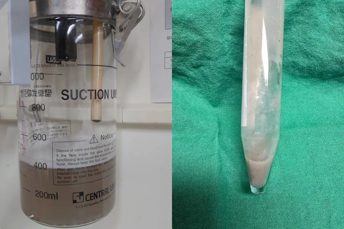 ▲有災民咳出的濃痰混有泥沙細石；醫師以支氣管鏡進行「清淤」，協助病人逐步恢復順暢呼吸。（圖／花蓮慈濟醫院提供）