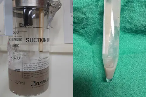 花蓮62歲災民咳濃痰！竟混泥沙、細石　花慈支氣管鏡「清淤」
