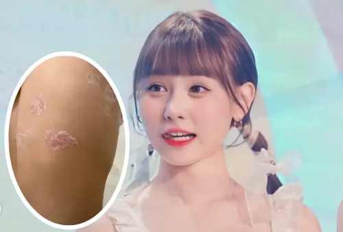 畇二身體浮出「大片紅色腫塊」！近照曝光認健康出問題：很後期了
