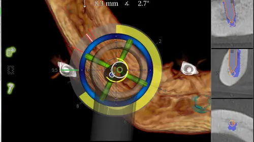 ▲台北慈濟醫院完成全球首例運用動態導航的「Jaw in a Day」手術，能即時顯示鑽孔深度、角度與位置。（圖／台北慈院提供）