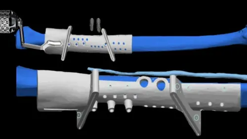 ▲「Jaw in a Day」術前得利用3D列印技術製作各式切削導板，並進行模擬比對。（圖／台北慈院提供）