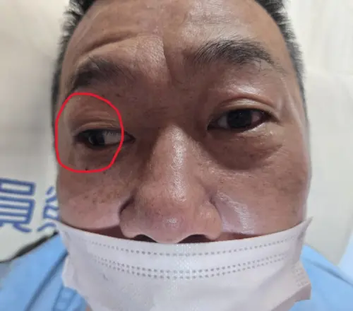 ▲男子午休醒來發現自己視力模糊頭暈，以為中暑，但因為眼球怪怪，到醫院就醫，被診斷為「缺血性腦中風」。（圖／員榮醫院提供）