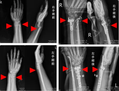 市醫3主治協同手術 多處骨折僅1小時修復創紀錄
