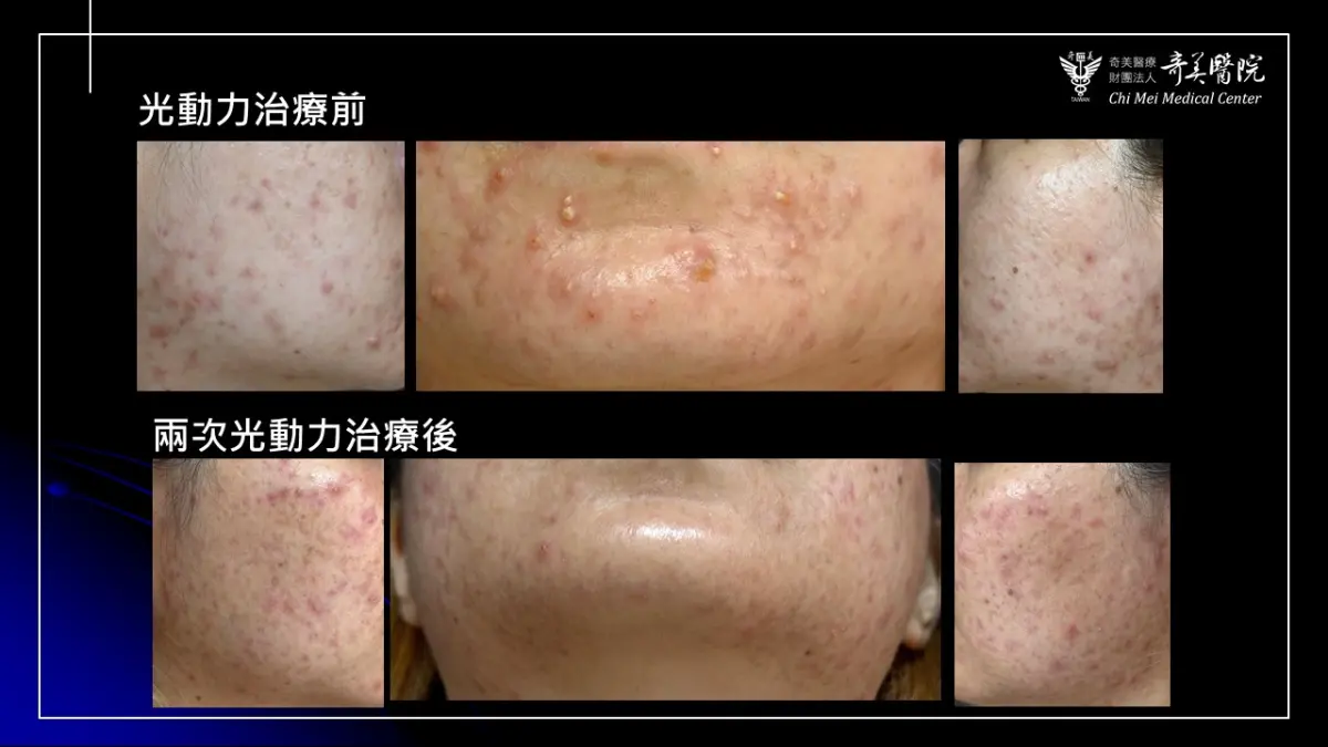 ▲林小姐臉頰、下巴的紅色丘疹及膿皰，經2次光動力療法搭配外用藥物治療後明顯改善。（圖／奇美醫院提供）