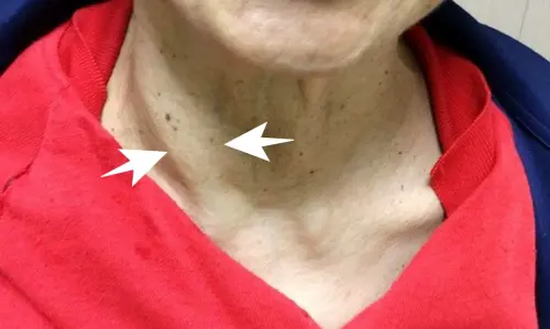 ▲女子頸部右側甲狀腺有明顯突起，後確診為副甲狀腺癌。（圖／王子源醫師提供）