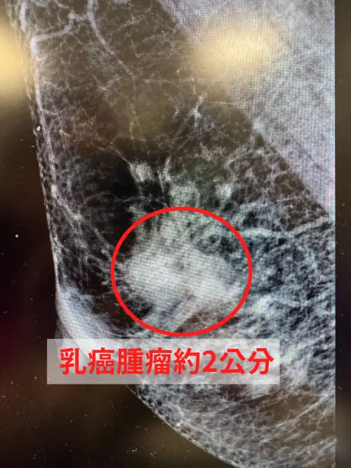 ▲婦人乳頭濕疹反覆發作，檢查竟是乳癌第2期。（圖／中醫大新竹附醫提供）