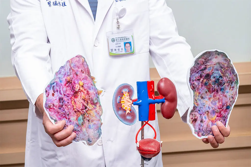 ▲陳老師因多囊腎導致腎臟異常腫大，切除後雙側病腎合計重達6公斤，體積為常人20倍。（圖／彰基提供）