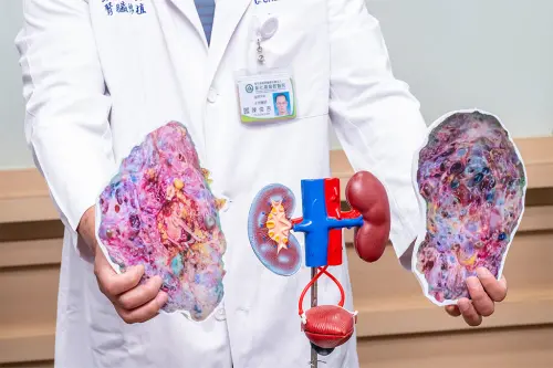 多囊腎腫大20倍！她2顆腎重達6kg　微創手術切除＋移植成功救命
